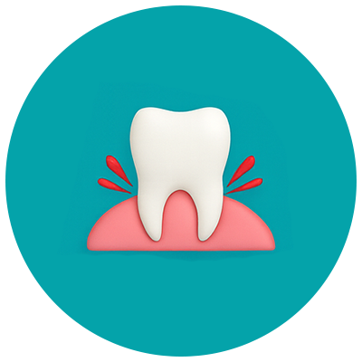 Wisdom Teeth Extraction